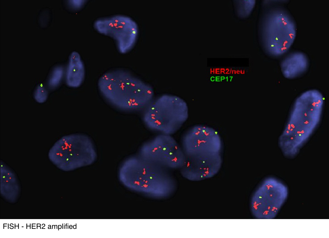 HER2 FISH Amplification
